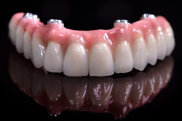 When Are Implant Supported Dentures Recommended?