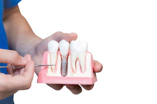 What To Know Before Getting Mini Dental Implants