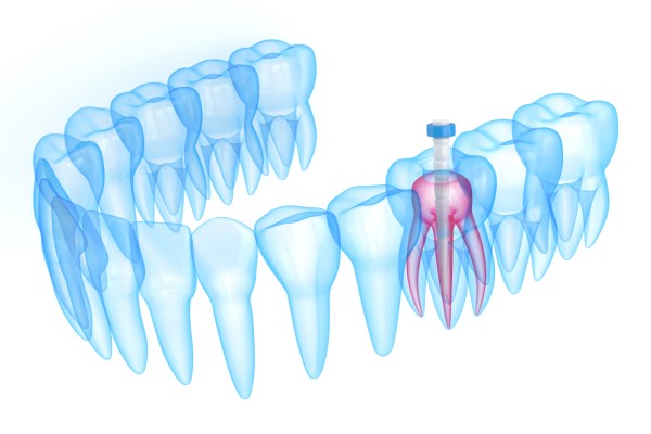 When You May Want To Consider A Root Canal